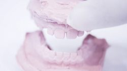 Full Mouth Implants in Houston TX