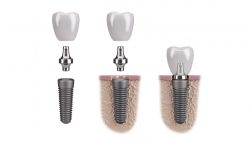 Affordable Dental Implants in Houston, TX | Dental Implant Pricing Options