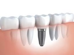 Single Tooth Implant Replacement