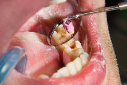 impacted wisdom teeth removal | Dentist Houston TX Clinic