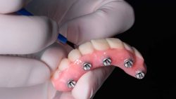 Full Mouth Dental Veneers Near Me | gaps in teeth or make crooked
