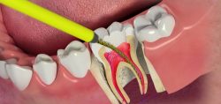 veneers for front teeth gap | Dental Veneers can also hide