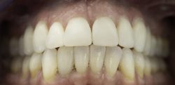 Teeth Bonding Near Me in Houston | Teeth Restoration