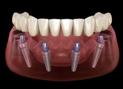 All on 4 Dental Implants in a Day