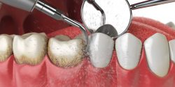 Affordable Dentures Near Me | Flexible Partial Dentures | Tooth Replacement Cost | flexible dentures