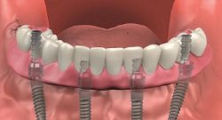 Emergency Wisdom Tooth Extraction Near Me | Impacted Wisdom Tooth | emergencydentistinhouston