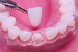 Wisdom Tooth Extraction Near Me | permanent dentures