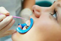 Dental Sealants for Kids in Miami | Dental Sealants For Teeth