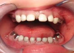 Pediatric Stainless Steel Crowns | Stainless Steel Dental Crowns