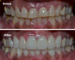 Crowns On Front Teeth Before And After