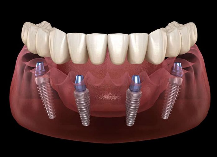 What Is Dental Implant?