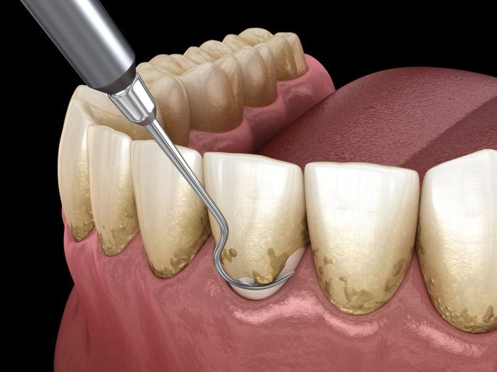 Signs of Gingivitis Symptoms