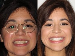 What Are The Differences Between Lumineers And Veneers?