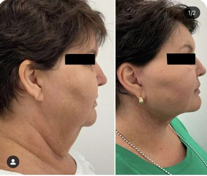 Neck Liposuction Surgeons Houston TX | Neck Liposuction Near Me