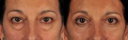 How Much Does Eye Lift Surgery Cost? – Premiere Surgical Arts