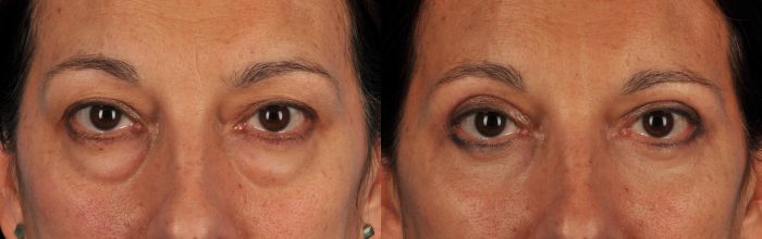 How Much Does Eye Lift Surgery Cost? – Premiere Surgical Arts