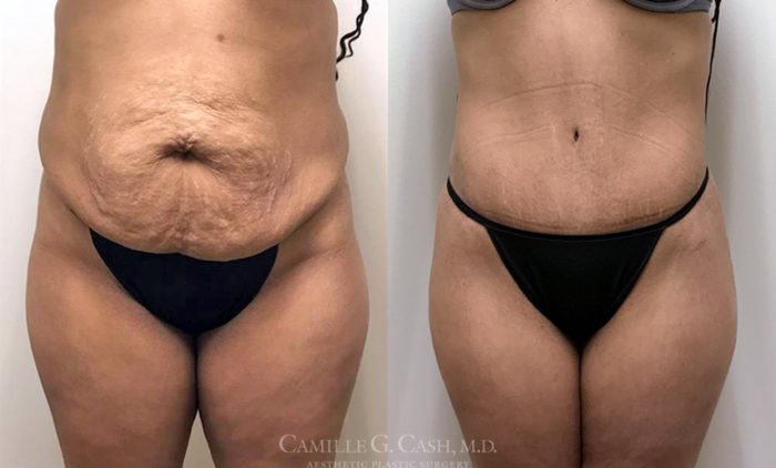 Tummy Tuck Houston