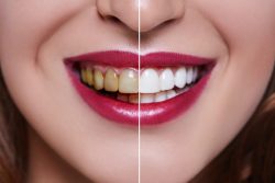 Dental Veneer Houston