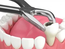 Dental Bone Grafting After Teeth Extraction