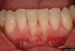 Gum Recession Treatment | Gum Regeneration Treatment