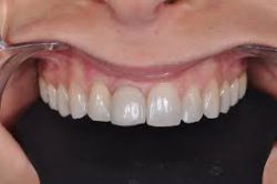 Dental Crown Replacement in Houston