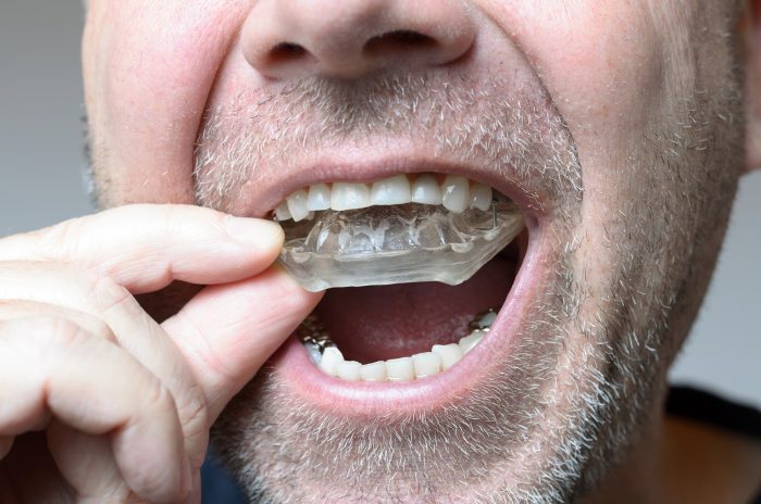 Dental Night Guard For Teeth Grinding | Prevent Teeth Grinding