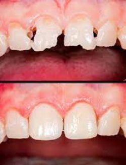Cosmetic Dental Bonding Cost | Teeth Bonding