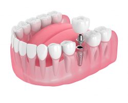 Dental implant dentist