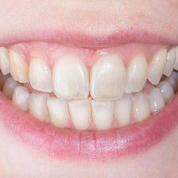 Fluoride Treatment For Teeth | Fluoride Varnish
