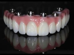 Full Teeth Replacement in Houston TX