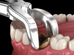 Wisdom Teeth Removal Houston,TX | Tooth Extraction Services