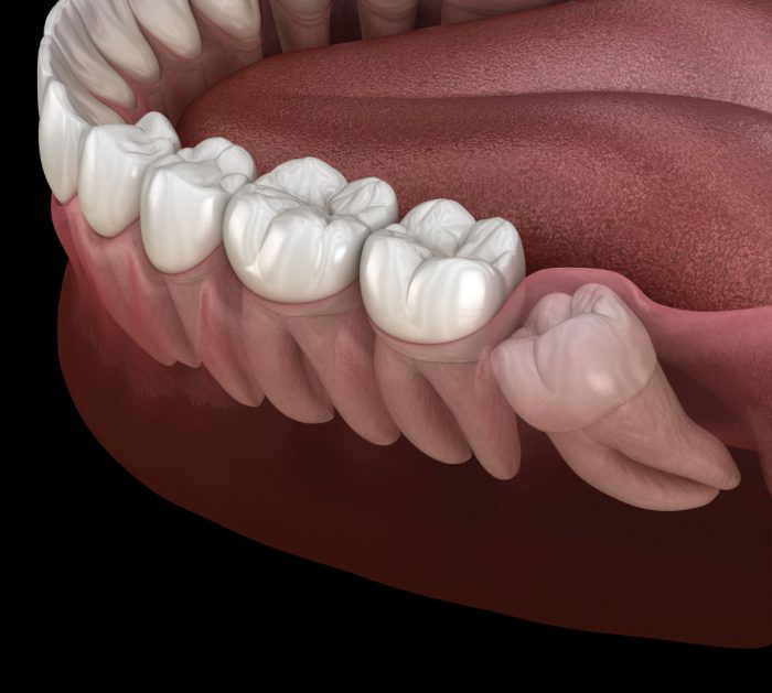 Wisdom Teeth Removal Houston