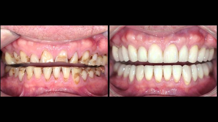 Full Mouth Restoration In Houston