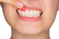 Gum Regeneration Surgery in Houston | laserdentistrynearme