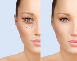How Much Does Eye Lift Surgery Cost? | lower and upper eyelids