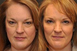 How Much Does Eye Lift Surgery Cost? | improve the appearance