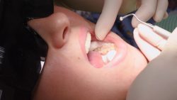 Composite Dental Fillings in Houston TX