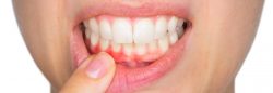 Signs of Gingivitis And Periodontitis