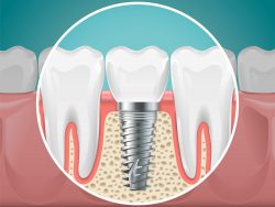 Full Teeth Replacement in Houston