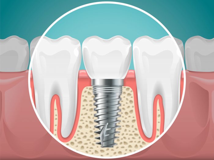 Full Teeth Replacement in Houston