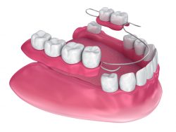 Best Tooth Replacement Options For Missing Teeth | Affordable Tooth Replacement Options