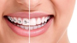 What Is Different In Adult Orthodontics?