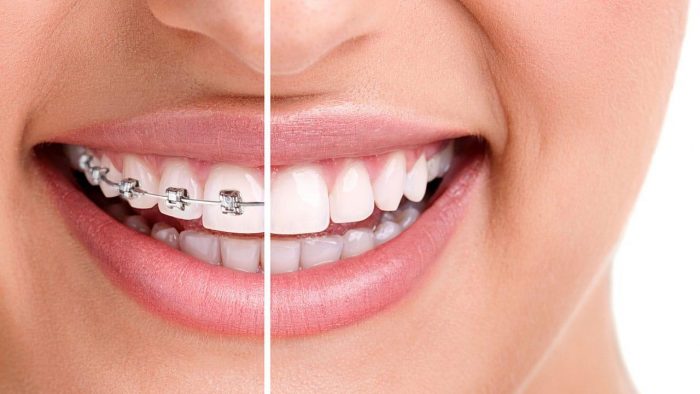 What Is Different In Adult Orthodontics?