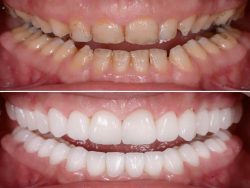 Gingival Recession Treatment in Houston | laserdentistrynearme