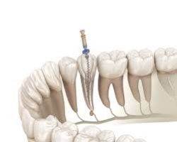 Walk-In Dental Treatment in Houston