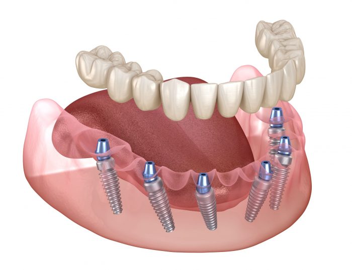 Professional Teeth Whitening Near me | metlife find a dentist