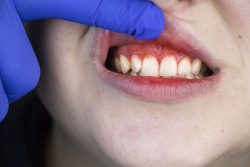 Causes Of Gingival Recession | laserdentistrynearme
