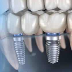 Dental Implants Cost Near Me | Dental Implant Fixing
