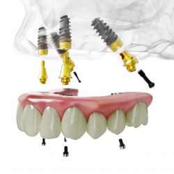 Dental Implant Prices | Tooth Implant Cost & Benefits