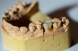same day dental crowns in Houston | Dental Crowns